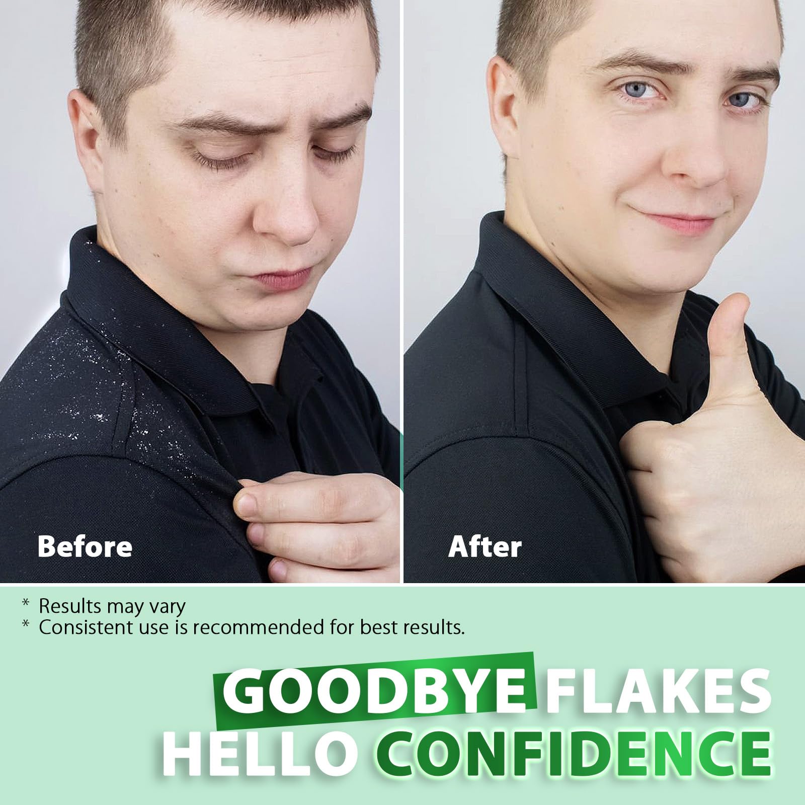 Antifungal Shampoo for Folliculitis and Seborrheic Dermatitis: Scalp Psoriasis Treatment, Dandruff & Itchy Scalp Relief with Salicylic Acid, Piroctone Olamine, Rosemary & Coconut Oil 8.8 fl.oz