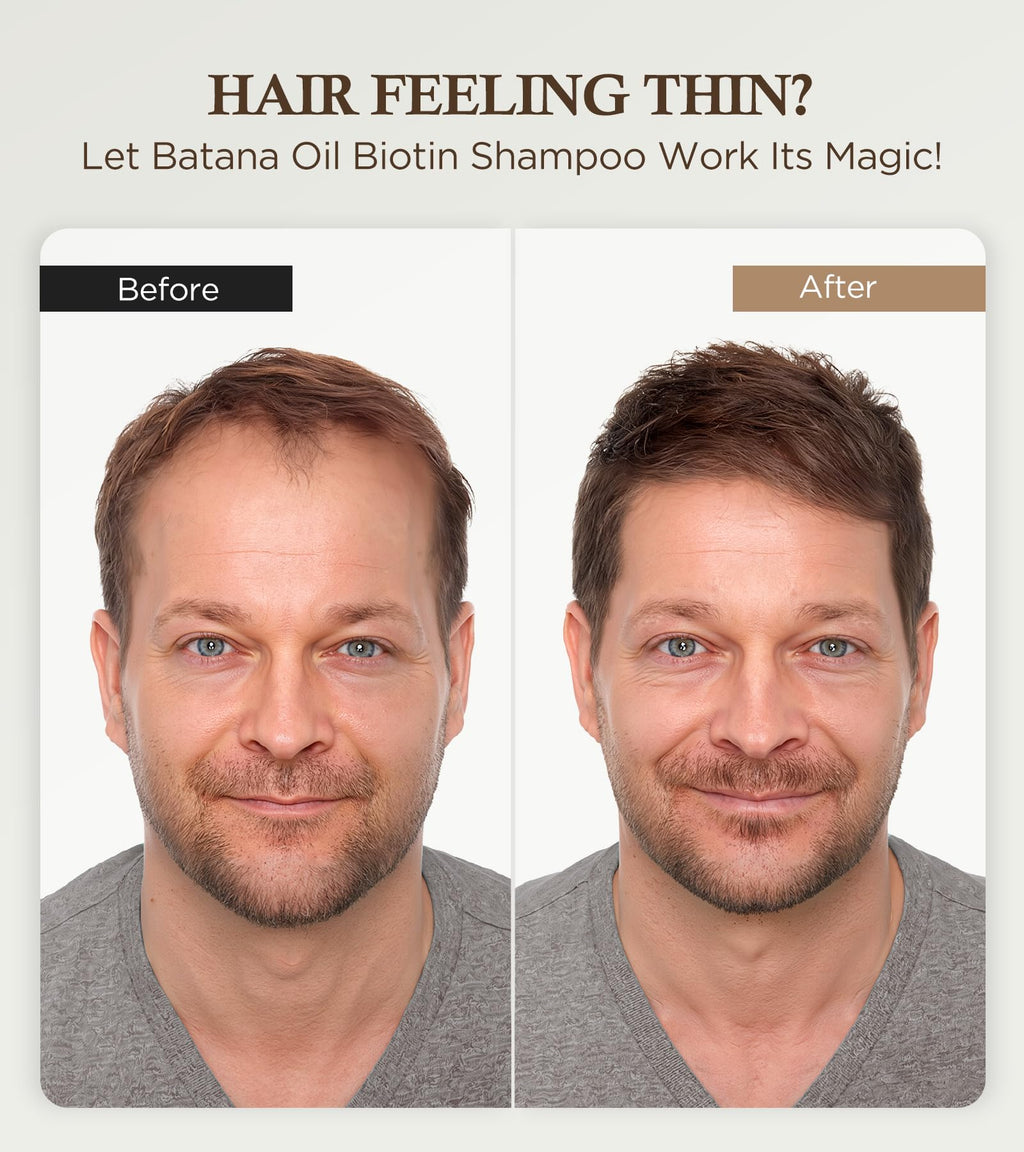 99% Pure Biotin Shampoo for 3X Thicker, Fuller Hair Growth, 80% Less Hair Loss w/Thuja Extract, Batana & Noni Fruit Oil Hair Care for Deep Nourishing,Rosemary Dandruff Treatment for Men Women,11.83oz